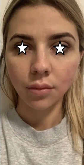 دکتر مه گل فرجادنیا، کلینیک ماهبد، لیفت با نخ ، لیفت صورت با نخ، بهترین مرکز لیفت با نخ ایران، بهترین مرکزلیفت با نخ تهران، بهترین مرکز لیفت با نخ شمال تهران