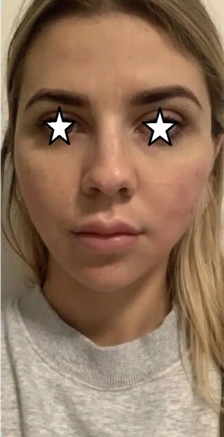 دکتر مه گل فرجادنیا، کلینیک ماهبد، لیفت با نخ ، لیفت صورت با نخ، بهترین مرکز لیفت با نخ ایران، بهترین مرکزلیفت با نخ تهران، بهترین مرکز لیفت با نخ شمال تهران