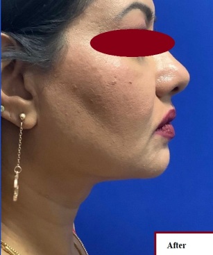 دکتر مه گل فرجادنیا، کلینیک زیبایی ماهبد، ساکشن غبغب کلینیک ماهبد، ساکشن غبغب، باکال فت، بهترین مرکز ساکشن غبغب، کلینیک مهرزاد، بهترین مرکز ساکشن غبغب جردن، بهترین مرکز ساکشن غبغب ظفر، بهترین مرکز ساکشن غبغب شمال تهران 