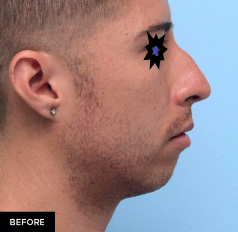 ساکشن غبغب، تزریق چانه و زاویه سازی