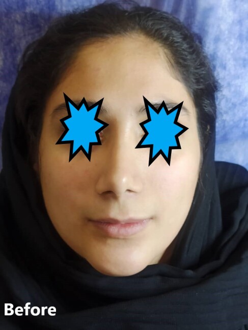 تزریق لب نچرال 