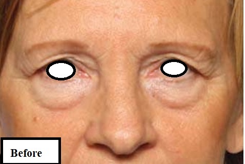 بلفاروپلاستی رژنراتیو پلک بالا و پایین