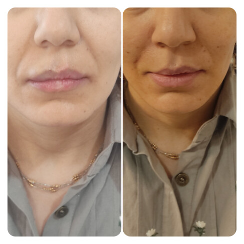 تزریق فیلر لب، اصلاح فرم لب و قرینه سازی