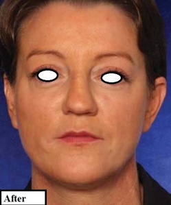 دکتر مه گل فرجادنیا، کلینیک ماهبد، تزریق چربی ، تزریق چربی تخصصی ، تزریق نانوفت ، تزریق چربی صورت، بهترین تزریق چربی تهران 