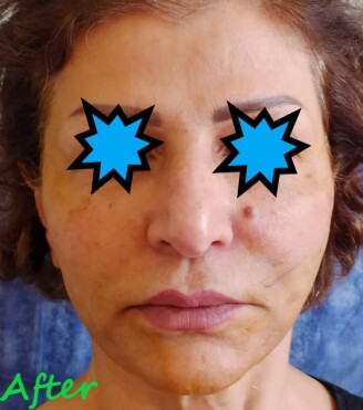 دکتر مه گل فرجادنیا، کلینیک زیبایی ماهبد، لیفت با نخ در کلینیک زیبایی ماهبد، لیفت با نخ صورت، لیفت غیر جراجی صورت، لیفت کلینیک زیبائی ماهبد، بهترین لیفت با نخ تهران، بهترین لیفت با نخ شمال تهران، بهترین لیفت با نخ جردن، بهترین لیفت با نخ ظفر