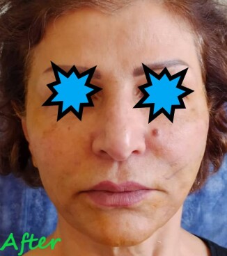 دکتر مه گل فرجادنیا، کلینیک زیبایی ماهبد، لیفت با نخ، لیفت با نخ صورت ، لیفت با نخ دکتر مه گل فرجادنیا، بهترین مرکز لیفت با نخ تهران، لیفت غیر جراحی صورت