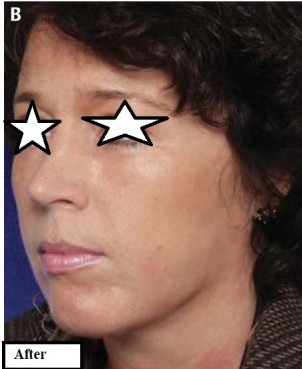 دکتر مه گل فرجانیا، کلینیک زیبایی ماهبد، تزریق چربی توسط دکتر مه گل فرجادنیا، تزریق چربی کلینیک ماهبد، تزریق چربی حرفه ای، نانوفت، میکروفت، بهترین تزریق چربی ایران، بهترین تزریق چربی شمال تهران، بهترین تزریق چربی ظفر تهران، بهترین تزریق چربی جردن