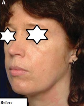 دکتر مه گل فرجانیا، کلینیک زیبایی ماهبد، تزریق چربی توسط دکتر مه گل فرجادنیا، تزریق چربی کلینیک ماهبد، تزریق چربی حرفه ای، نانوفت، میکروفت، بهترین تزریق چربی ایران، بهترین تزریق چربی شمال تهران، بهترین تزریق چربی ظفر تهران، بهترین تزریق چربی جردن