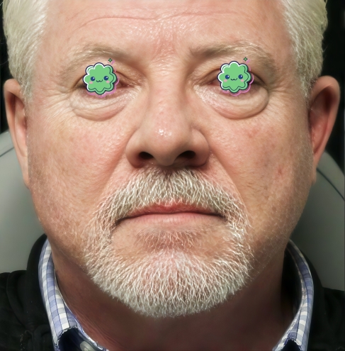 بلفاروپلاستی پلک پایین