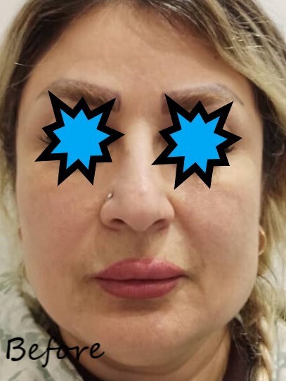 قرینه سازی لب فوقانی