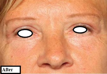 دکتر مه گل فرجادنیا، کلینیک ماهبد، بلفاروپلاستی کلینیک ماهبد، بلفاروپلاستی رژنراتیو، بلفاروپلاستی کلینیک ماهبد، بهترین بلفاروپلاستی تهران، بهترین بلفاروپلاستی ظفر؛ بهترین بلفاروپلاستی جردن