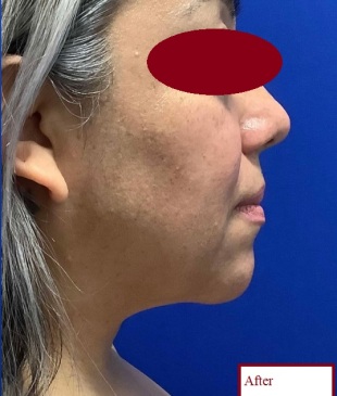 دکتر مه گل فرجادنیا، کلینیک زیبایی ماهبد، ساکشن غبغب کلینیک زیبایی ماهبد، ساکشن غبغب دکتر مه گل فرجادنیا ، باکال فت دکتر مه گل فرجادنیا، بهترین ساکشن غبغب تهران، بهترین ساکشن غبغب شمال تهران