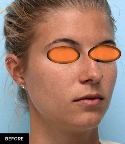 تزریق چانه و گونه