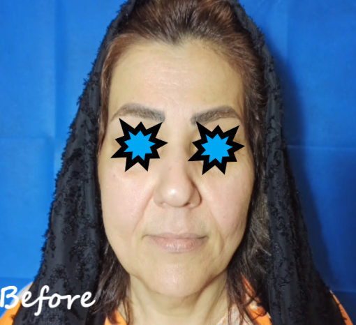 تزریق لب و لیفت عمودی