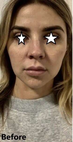 دکتر مه گل فرجادنیا، کلینیک ماهبد، لیفت با نخ ، لیفت صورت با نخ، بهترین مرکز لیفت با نخ ایران، بهترین مرکزلیفت با نخ تهران، بهترین مرکز لیفت با نخ شمال تهران