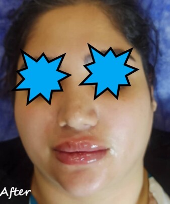 دکتر مه گل فرجادنیا، کلینیک زیبایی ماهبد، تزریق لب، تزریق لب روسی، تزریق لب عروسکی، تزریق لب ام، بهترین مرکز تزریق فیلر لب در تهران، بهترین مرکز تزریق فیلر لب در شمال تهران، بهترین مرکز فیلر لب در جردن، بهترین مرکز تزریق در ظفر