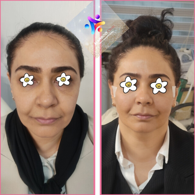 لیفت با نخ صورت در خانم میانسال 