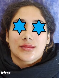 تزریق لب دکتر فرجادنیا ، تزریق لب کلینیک ماهبد، 
