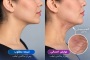 عوارض ساکشن غبغب چیست؟ هر آنچه قبل از انجام این روش باید بدانید؟ 