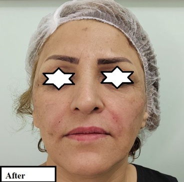 تزریق خط خنده در کلینیک ماهبد، تزریق خط خنده با فیلر ، تزریق خط خنده توسط دکتر فرجادنیا، nasilabial fold injection, nasolabial fold filler injection, nasolabial fold injection in Mahbod's Aesthetics Center, 