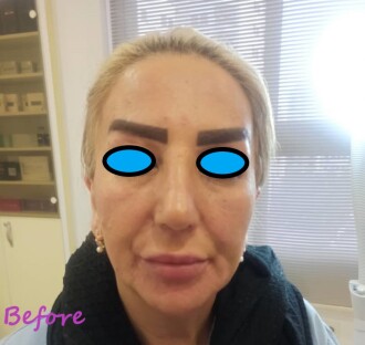 دکتر مه گل فرجادنیا، کلینیک زیبایی ماهبد،تزریق لب، بهترین مرکز تزریق لب ، تزریق لب کلینیک ماهبد، لیفت با فیلر دکتر مه گل فرجادنیا