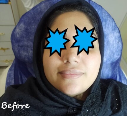 دکتر مه گل فرجادنیا، کلینیک زیبایی ماهبد، تزریق لب، تزریق لب روسی، تزریق لب عروسکی، تزریق لب ام، بهترین مرکز تزریق فیلر لب در تهران، بهترین مرکز تزریق فیلر لب در شمال تهران، بهترین مرکز فیلر لب در جردن، بهترین مرکز تزریق در ظفر