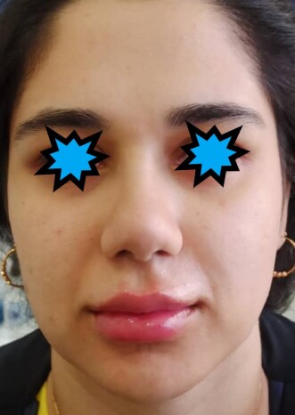 تزریق فیلر لب