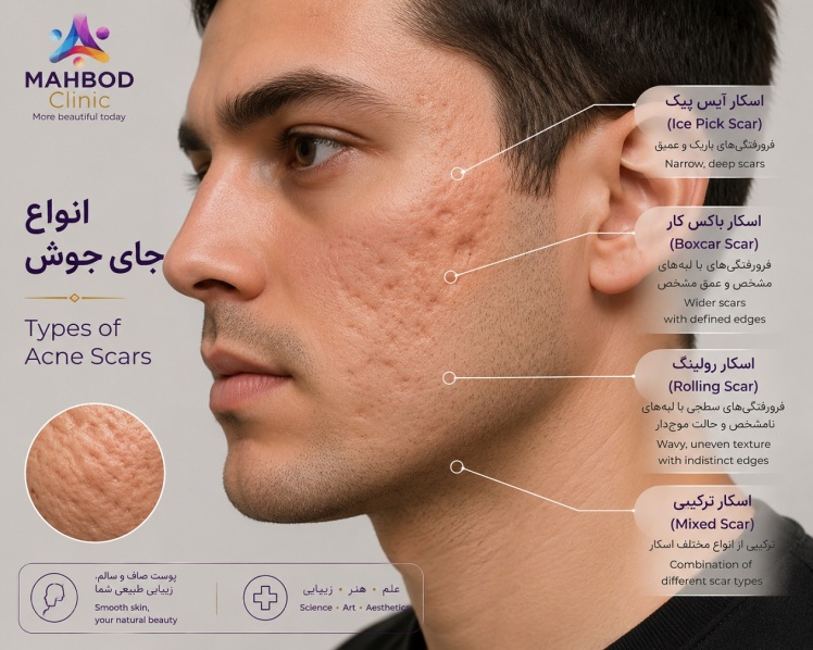 راههای درمان جای جوش؛ از سابسیژن و TCAcross تا لیزرهای ابلیتیو