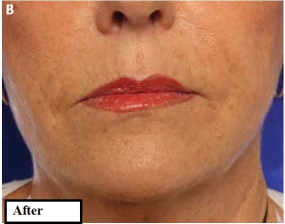 دکتر مه گل فرجادنیا، کلینیک زیبایی ماهبد، پیلینگ کمیکال در کلینیک ماهبد، از بین بردن چروکهای اطراف لب 