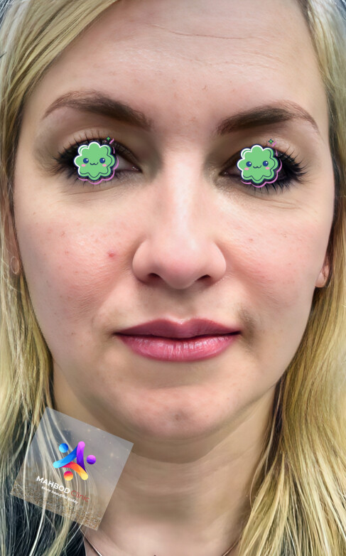 تزریق فیلر میدفیس 