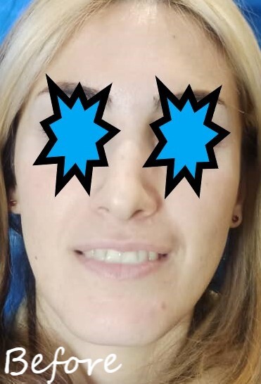 تزریق لب عروسکی 