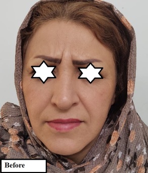 دکتر مه گل فرجادنیا، کلینیک زیبائی ماهبد، تزریق فیلر خط خنده، تزریق فیلر خط خنده در کلینیک ماهبد، بهترین مرکز تزریق خط خنده در تهران