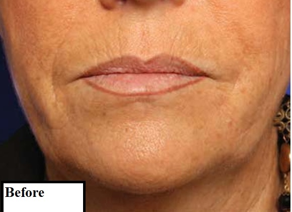 دکتر مه گل فرجادنیا، کلینیک زیبایی ماهبد، پیلینگ کمیکال در کلینیک ماهبد، از بین بردن چروکهای اطراف لب 