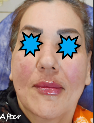 دکتر مه گل فرجادنیا، کلینیک زیبایی ماهبد، تزریق لب روسی ، تزریق لب حرفه ای ، تزریق لب ام، بهترین تزریق لب تهران ،زل لب 