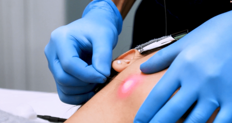 اندولیفت در کلینیک زیبایی ماهبد، اندولیفت توسط دکتر فرجادنیا، اندولیفت در ظفر، اندولیفت در جردن، اندولیفت در قبا، بهترین مرکز اندولیفت ایران، بهترین مرکز اندولیفت تهران اندولیفت در کلینیک زیبایی ماهبد، اندولیفت توسط دکتر فرجادنیا، اندولیفت در ظفر، اندولیفت در جردن، اندولیفت در قبا، بهترین مرکز اندولیفت ایران، بهترین مرکز اندولیفت تهران